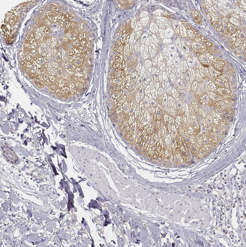 Immunohistochemical staining of human skin shows moderate cytoplasmic positivity in cells in sebaceous gland.