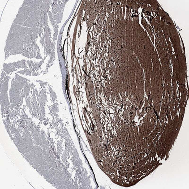 Immunohistochemical staining of human eye shows strong cytoplasmic positivity in lens fiber cells.