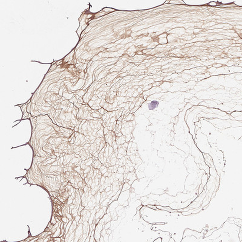 Immunohistochemical staining of human eye shows positivity in vitreous of the eye.