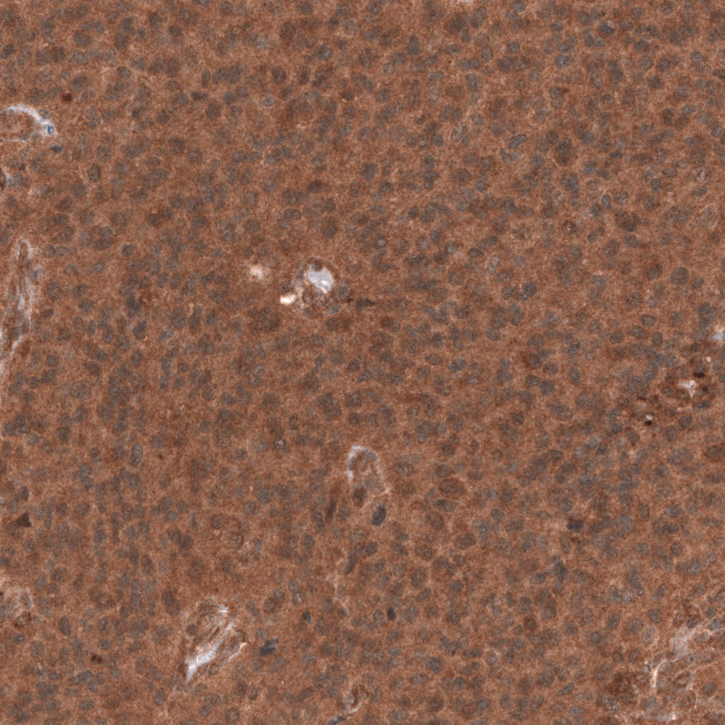 Immunohistochemical staining of human anaplastic oligodendroglioma shows strong cytoplasmic positivity in tumor cells.