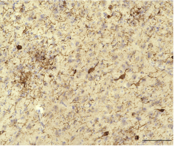 Immunostaining of AD brain section with Tau-N antibody. Neurofibrillary tangles, neuropil threads and dystrophic neurites surrounding senile plagues are stained with the antibodies. Scale bar: 100μm. Anti Tau-N antibody at 1/2000 dilution.