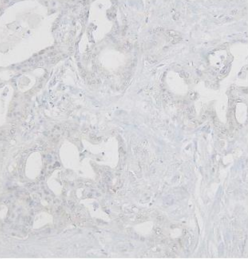 (Immunohistochemical staining of PODXL using resected pancreatic cancer tissues) Intense cytoplasmic PODXL staining was observed in ductal adenocarcinoma cells lining the tumor ducts, whereas the surrounding desmoplastic stroma exhibited complete absence of PODXL staining.Antibody dilution: 1:100
