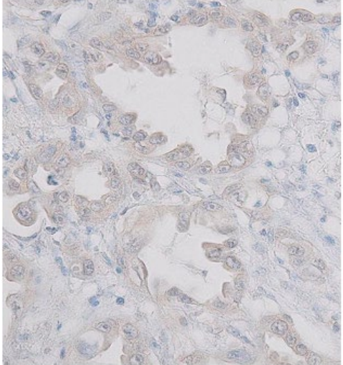 (Immunohistochemical staining of PODXL using resected pancreatic cancer tissues) Intense cytoplasmic PODXL staining was observed in ductal adenocarcinoma cells lining the tumor ducts, whereas the surrounding desmoplastic stroma exhibited complete absence of PODXL staining.
Antibody dilution: 1:200