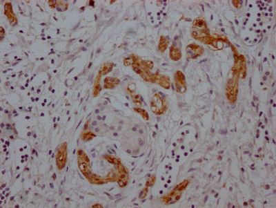 IHC image of CSB-RA276759A0HU diluted at 1:100 and staining in paraffin-embedded human pancreatic cancer performed on a Leica BondTM system. After dewaxing and hydration, antigen retrieval was mediated by high pressure in a citrate buffer (pH 6.0). Section was blocked with 10% normal goat serum 30min at RT. Then primary antibody (1% BSA) was incubated at 4℃ overnight. The primary is detected by a Goat anti-rabbit IgG polymer labeled by HRP and visualized using 0.05% DAB.