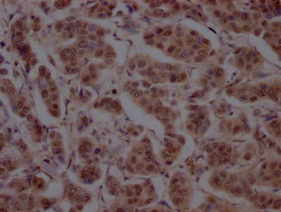IHC image of CSB-RA898115A0HU diluted at 1:100 and staining in paraffin-embedded human breast cancer performed on a Leica BondTM system. After dewaxing and hydration, antigen retrieval was mediated by high pressure in a citrate buffer (pH 6.0). Section was blocked with 10% normal goat serum 30min at RT. Then primary antibody (1% BSA) was incubated at 4℃ overnight. The primary is detected by a Goat anti-rabbit IgG polymer labeled by HRP and visualized using 0.05% DAB.