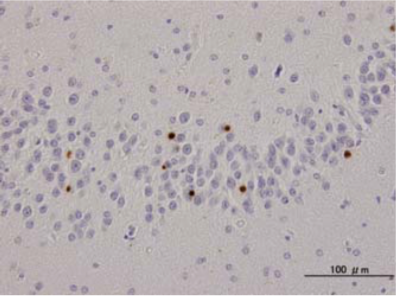 Figure 2. Immunohistochemistry of TDP-43 lesions.Neuronal cytoplasmic inclusions in dentate gyri of frontotemporal lobar degeneration (FTLD-U) are specifically stained. Bars 100 um.mAb pS409/410 stains ubiquitin-positive inclusions in FTLD-U and ALS without nuclear staining. It does not stain ghost tangles and granulovacuolar degeneration in AD or other related diseases by immunohistochemistry.