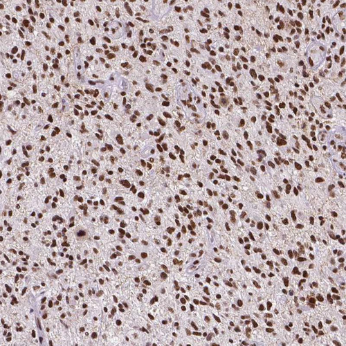 Immunohistochemical staining of human glioma shows strong nuclear positivity in tumor cells.