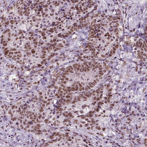 Immunohistochemical staining of human stomach cancer shows moderate nuclear positivity in tumor cells.