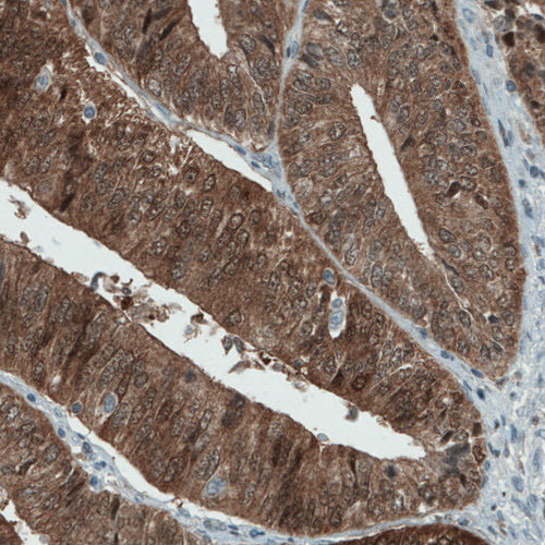 Immunohistochemical staining of human endometrial cancer shows strong immunoreactivity in tumor cells.