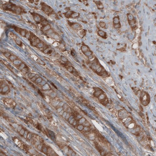 Immunohistochemical staining of human breast cancer shows cytoplasmic immunoreactivity in tumor cells.