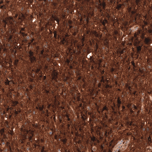 Immunohistochemical staining of human astrocytoma shows strong cytoplasmic positivity in tumor cells.