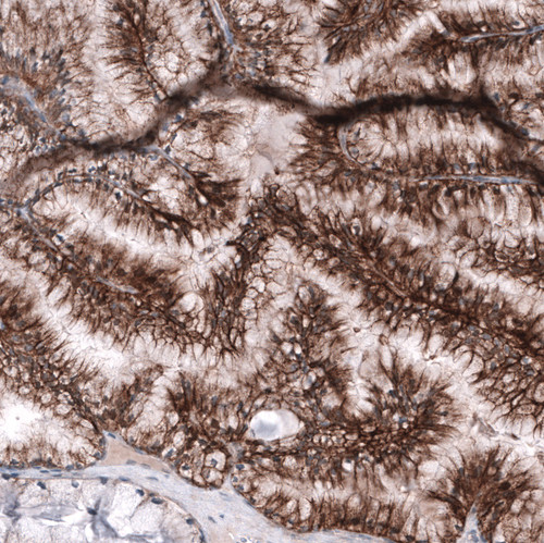 Immunohistochemical staining of human ovarian cancer (mucinous carcinoma) shows moderate membranous positivity in tumor cells.