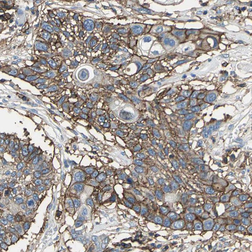 Immunohistochemical staining of human squamous cell lung carcinoma shows strong membranous positivity in tumor cells.