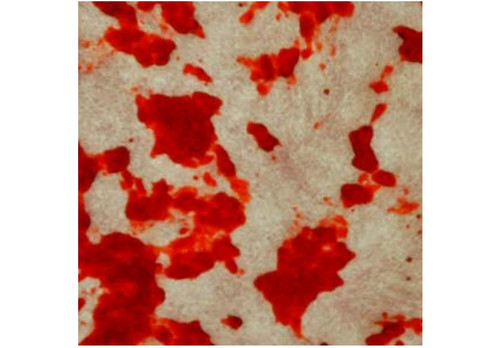 Calcified Nodule Extraction Solution