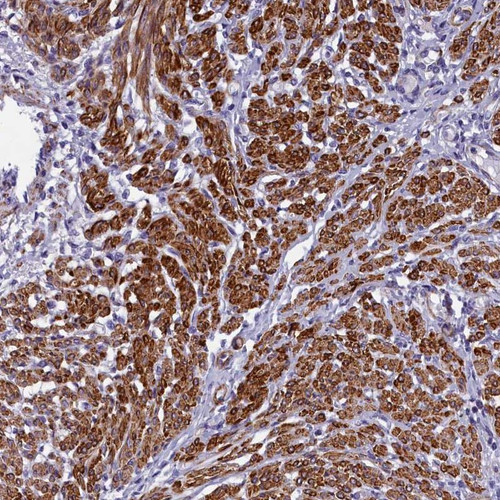 Immunohistochemical staining of human smooth muscle shows strong cytoplasmic positivity was observed in smooth muscle cells.