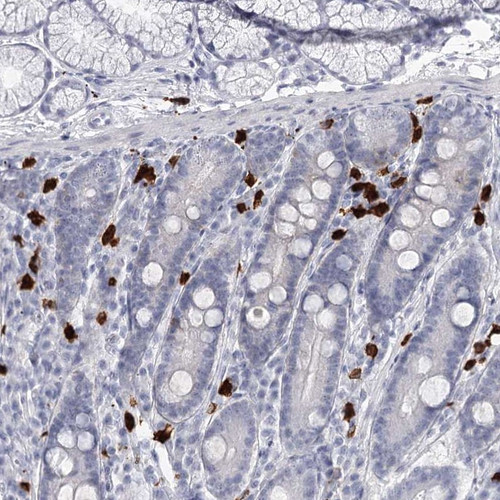 Immunohistochemical staining of human duodenum shows strong cytoplasmic positivity in inflammatory cells.