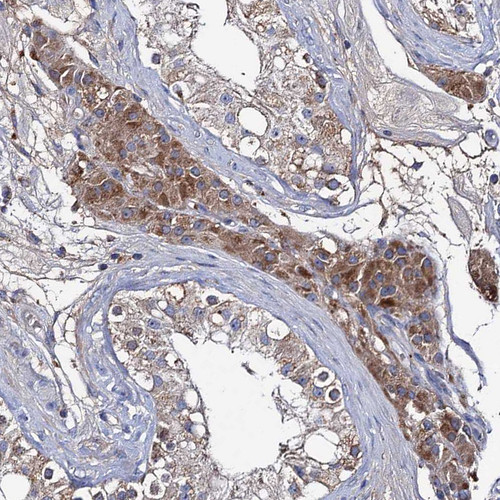 Immunohistochemical staining of human testis shows moderate granular cytoplasmic positivity in Leydig cells.
