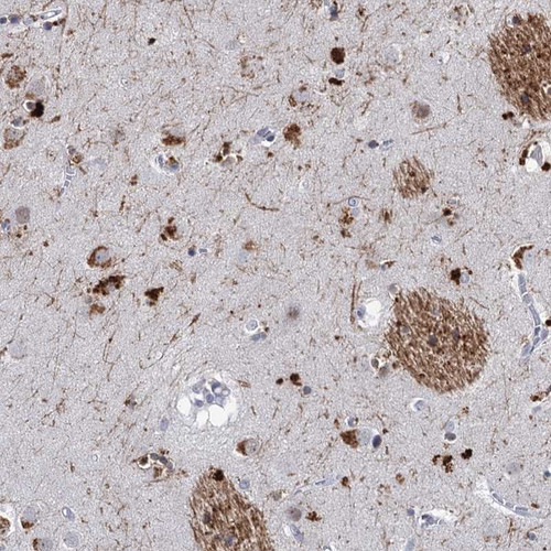Immunohistochemical staining of human caudate shows strong cytoplasmic positivity in neuronal cells.
