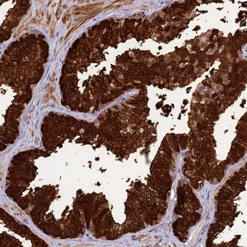 Immunohistochemical staining of human prostate shows strong cytoplasmic and nuclear positivity in glandular cells.