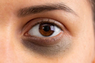 ​Black Eyes - Symptoms And Causes