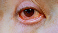 ​Giant Papillary Conjunctivitis: Causes, Symptoms And Treatment