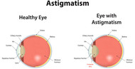 Astigmatism - Causes And Types