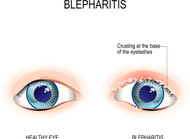 Is it Dry Eyes, Blepharitis or MGD – Well! Here is a solution