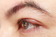 Blepharitis And Its Treatment