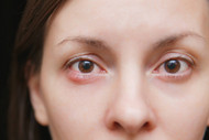 Chalazion or Styes – Get rid of the Red Eye Bumps