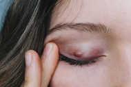 ​Chalazion and Stye - Symptom, Diagnosis And Treatment