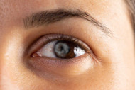 ​Coloboma: Symptoms, Diagnosis and Treatment