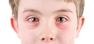 ​Conjunctivitis and Its Types