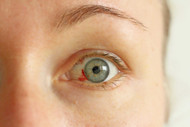 Corneal Laceration: Causes, Symptoms, Diagnosis And Treatment