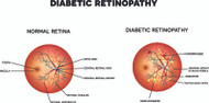 Diabetic Retinopathy – Symptoms, Diagnosis and Treatment
