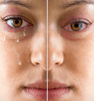 ​Is Dry Eyes or Tear Dysfunction Syndrome similar or different?