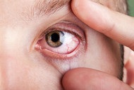 ​Relationship between Tear Hyperosmolarity and Dry Eyes