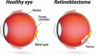 Eye cancer and Types