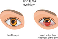 Hyphema: Symptoms, Causes, Diagnosis And Treatment