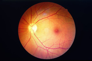 ​Diabetic Retinopathy And Its Types