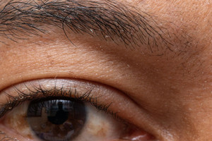 ​Herpes zoster: Symptoms And Treatment