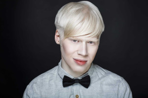 Albinism - Causes, Types And Symptoms