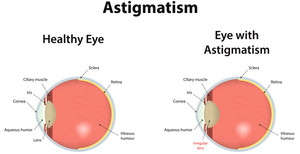 Astigmatism - Causes And Types