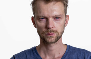 ​Bacterial Keratitis - Symptoms, Causes And Treatment