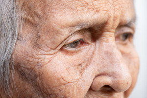 Dementia, Alzheimer’s Disease and The Eyes