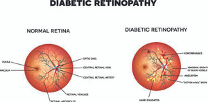 Diabetic Retinopathy – Symptoms, Diagnosis and Treatment