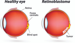 Eye cancer and Types