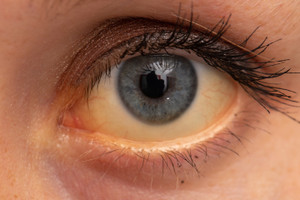 ​Iridocorneal Endothelial Syndrome