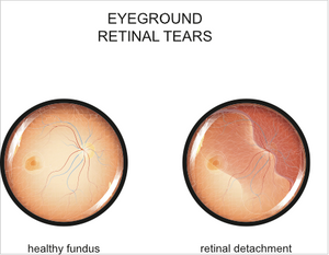 Retinal Tear and Detachment