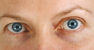 Juvenile Idiopathic Arthritis Uveitis: Symptoms, Diagnosis And Treatment