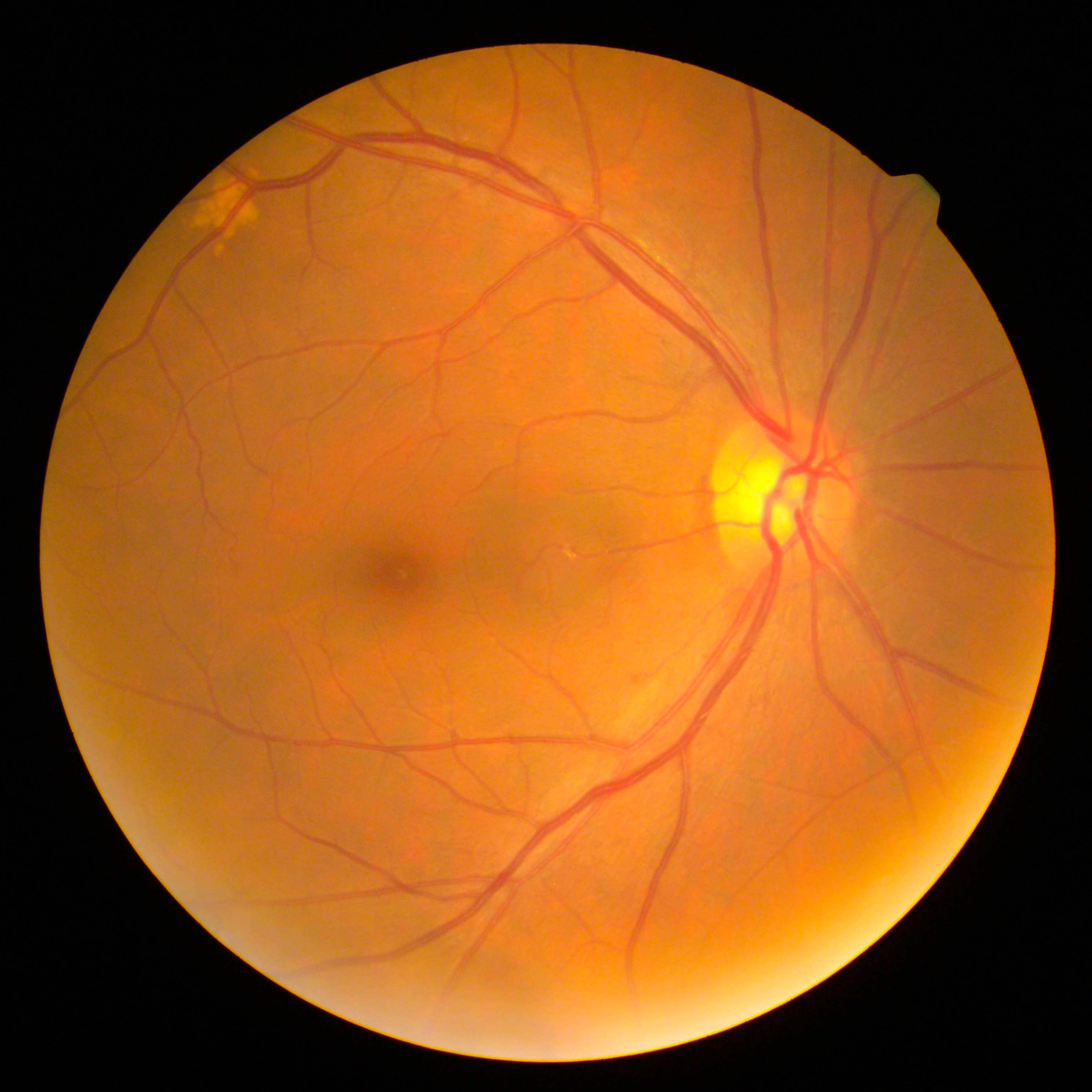 cmv retinitis